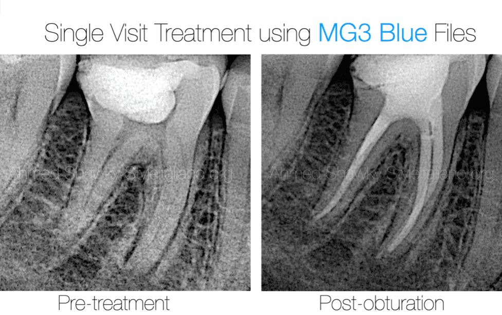 The Blue Power: Safe and predictable shaping with MG3 BLUE