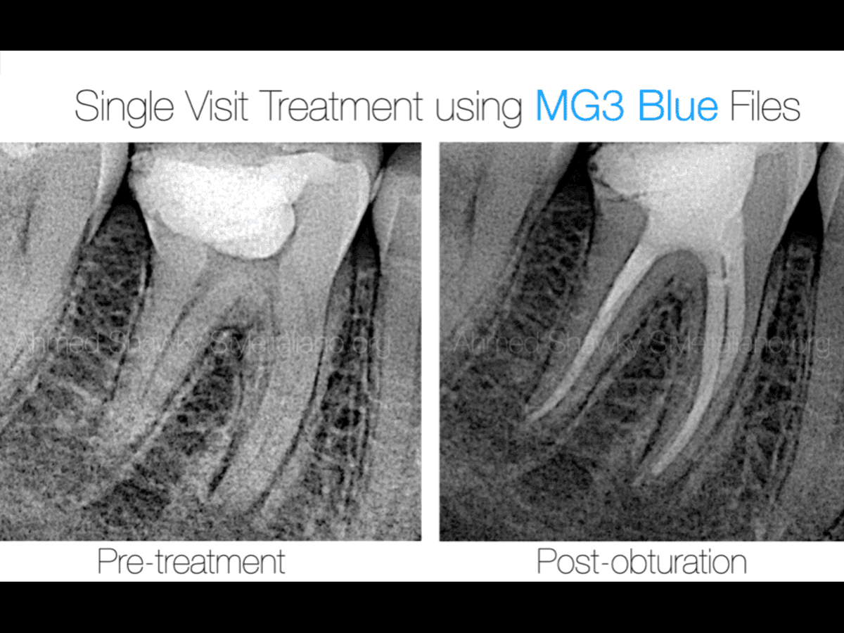 The Blue Power: Safe and predictable shaping with MG3 BLUE