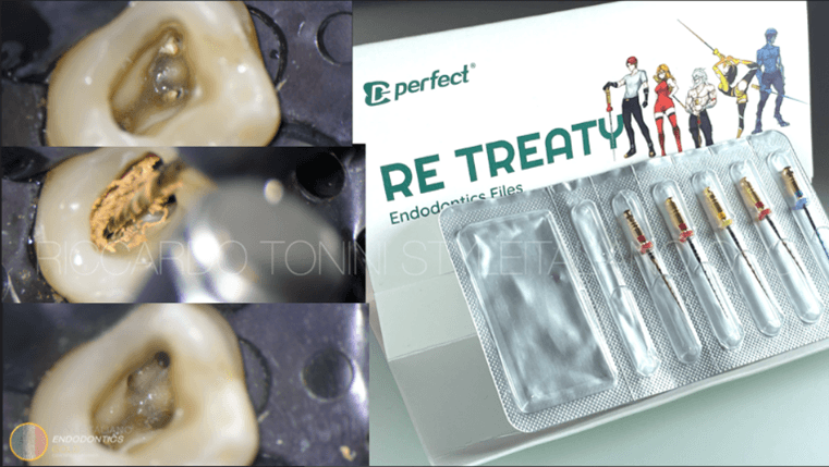Retreatment of an upper first molar made with the Retreaty kit by Perfect Endo Riccardo Tonini